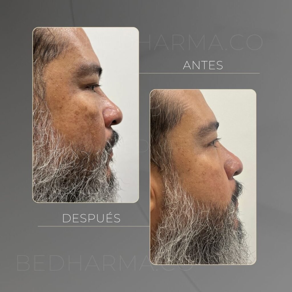 Antes y después Colormax en Medellín - Centro Estético Be Dharma