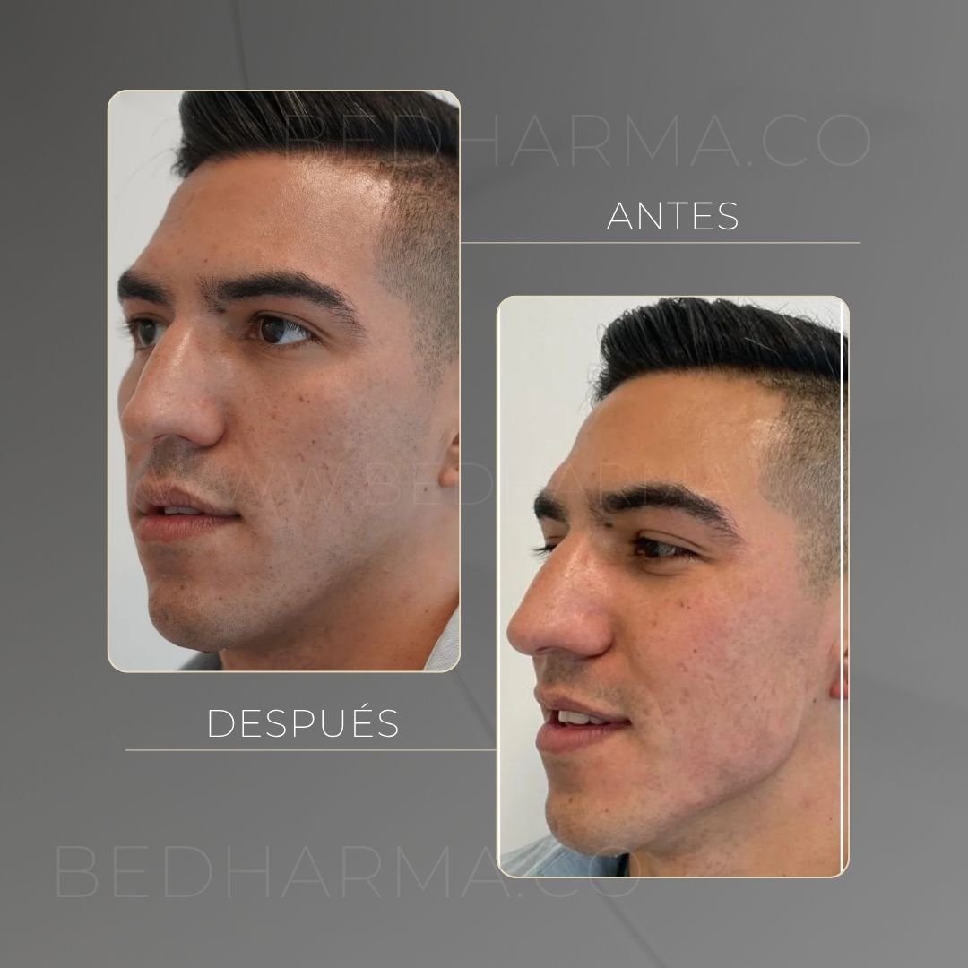 Antes y después Radiesse en Medellín - Centro Estético Be Dharma