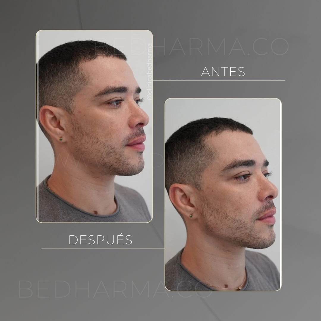 Antes y después Radiesse en Medellín - Centro Estético Be Dharma