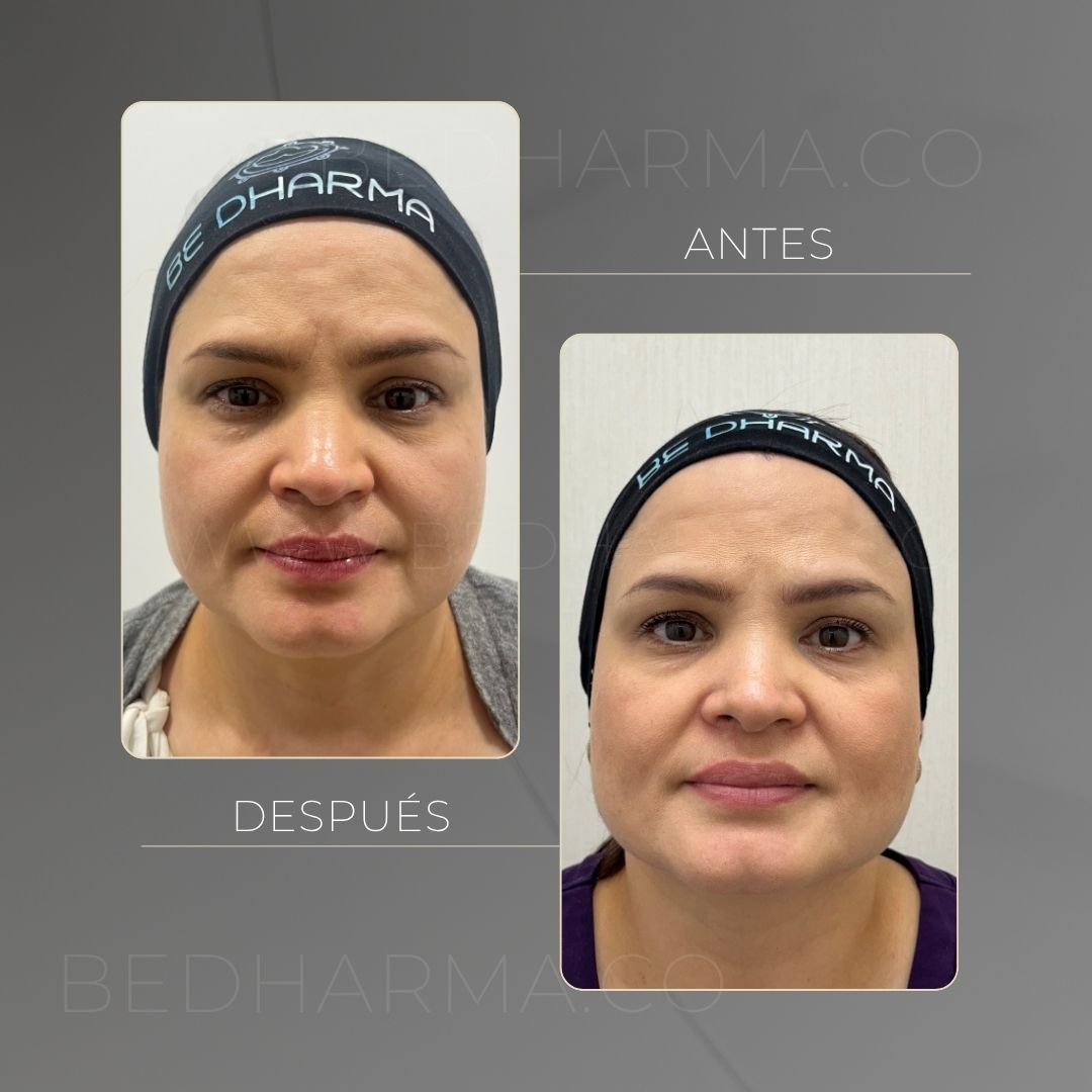 Antes y después Ultraformer en Medellín - Centro Estético Be Dharma
