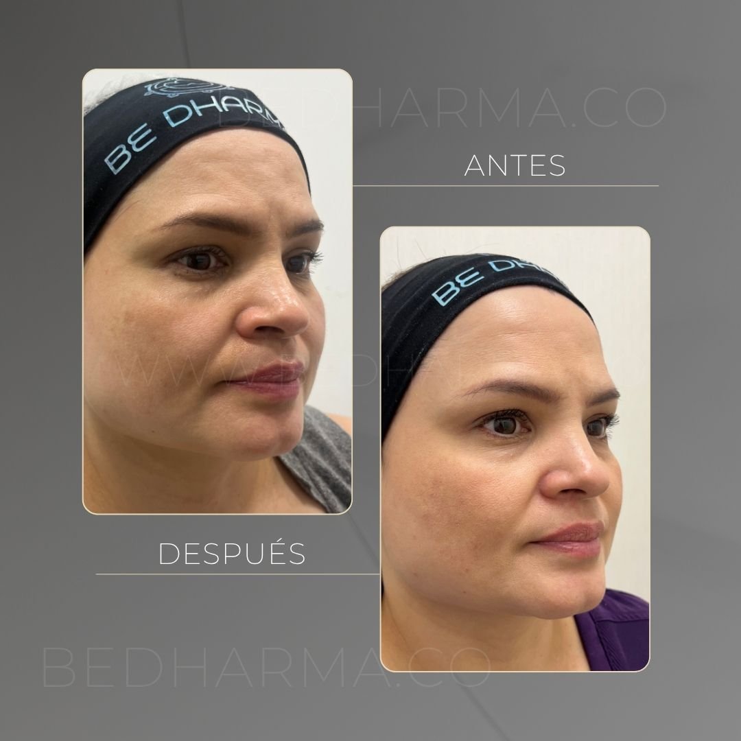 Antes y después Ultraformer en Medellín - Centro Estético Be Dharma