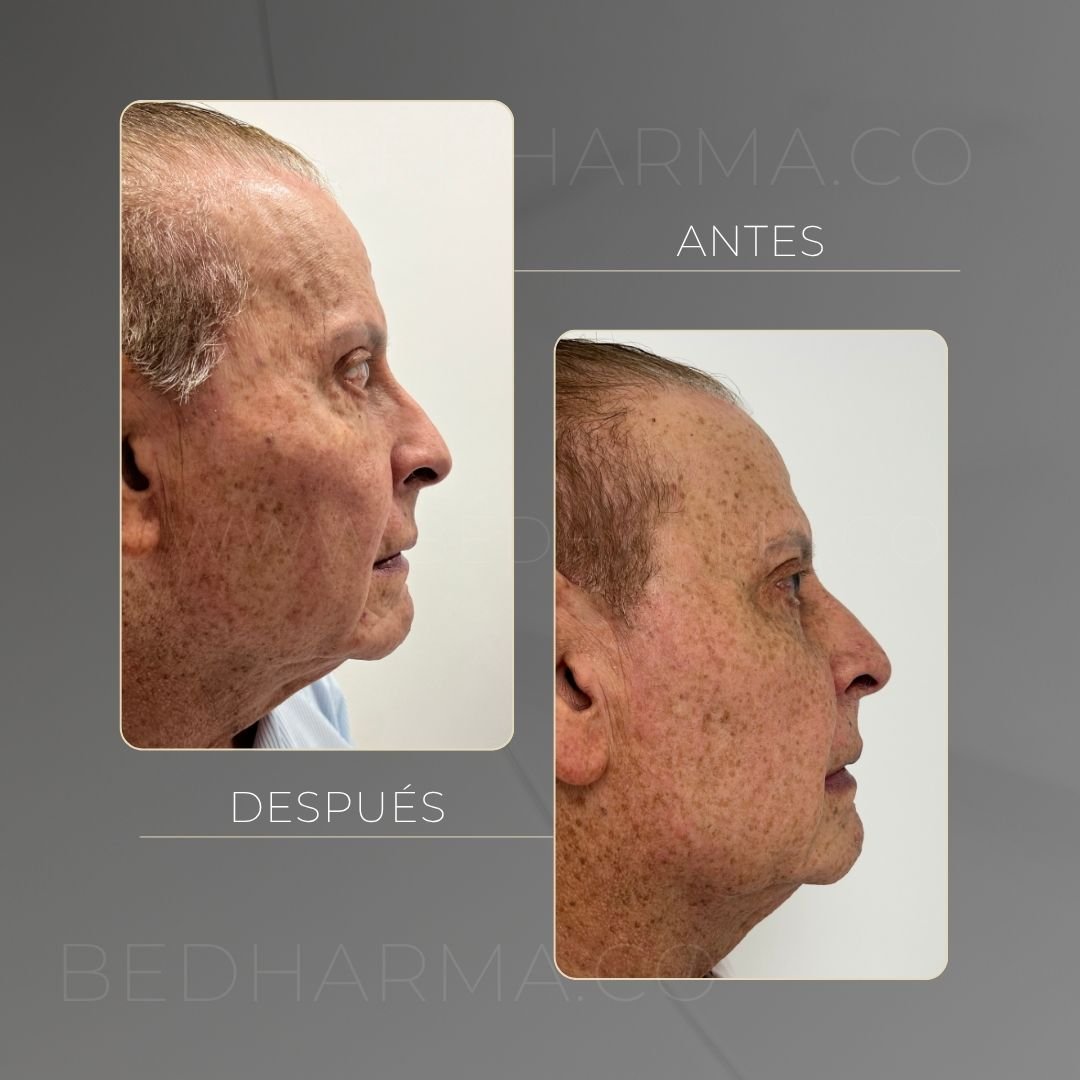Antes y después Ultraformer en Medellín - Centro Estético Be Dharma