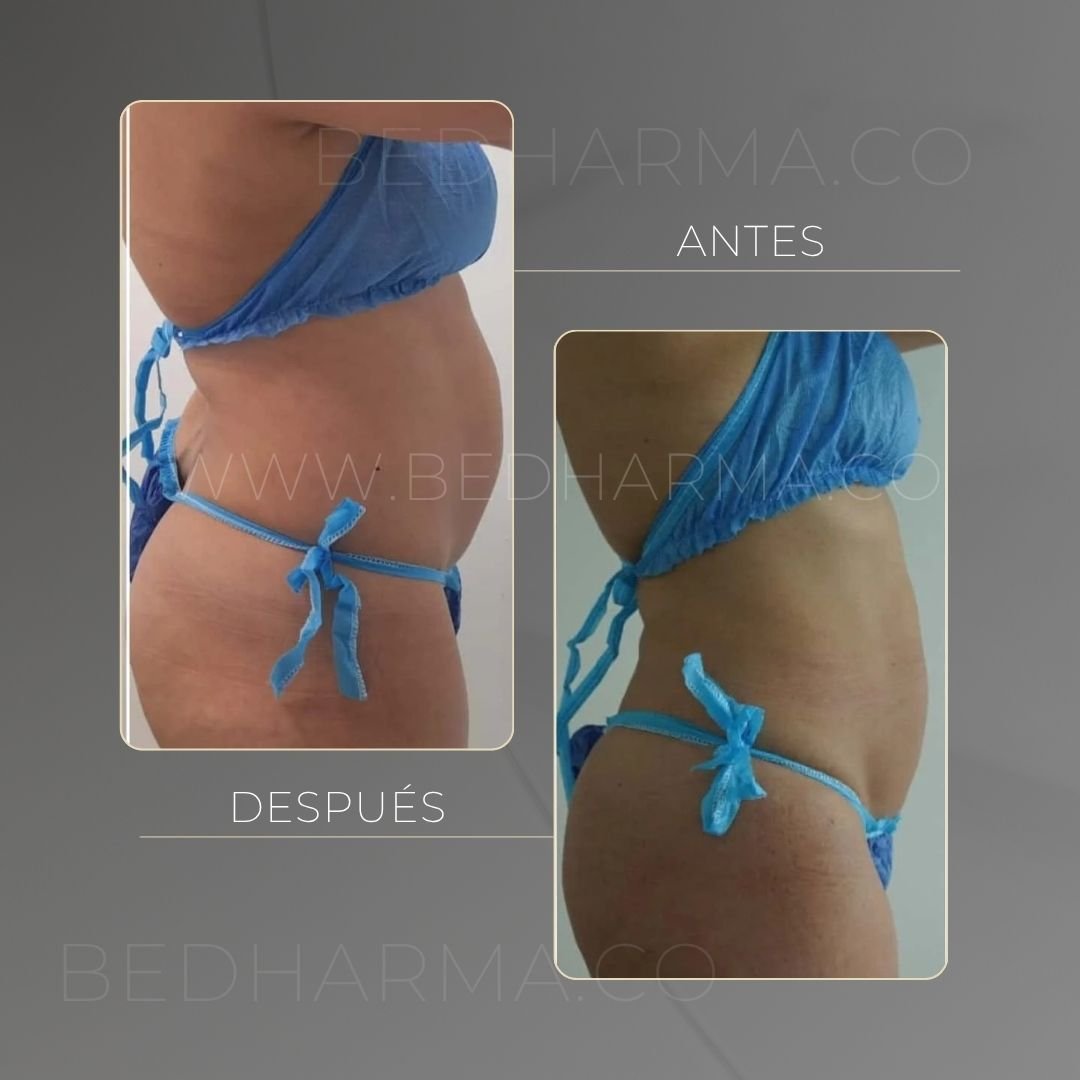 Antes y después de Cooltech para el rejuvenecimiento de la piel en Medellín - Centro Estético Be Dharma