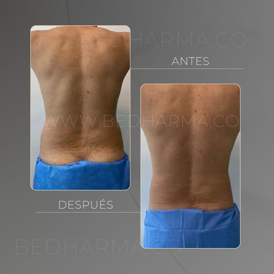 Antes y después de Cooltech para el rejuvenecimiento de la piel en Medellín - Centro Estético Be Dharma