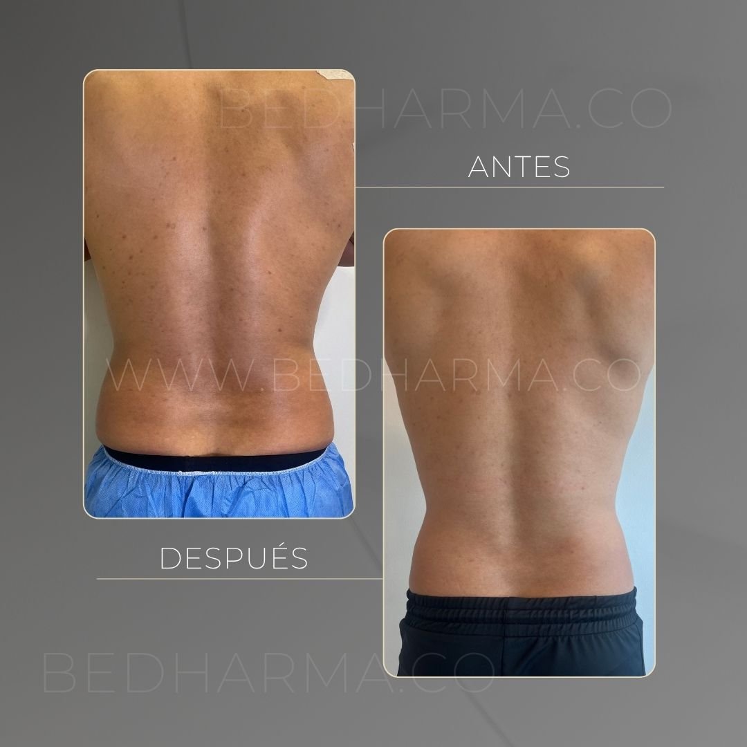 Antes y después de Cooltech para el rejuvenecimiento de la piel en Medellín - Centro Estético Be Dharma