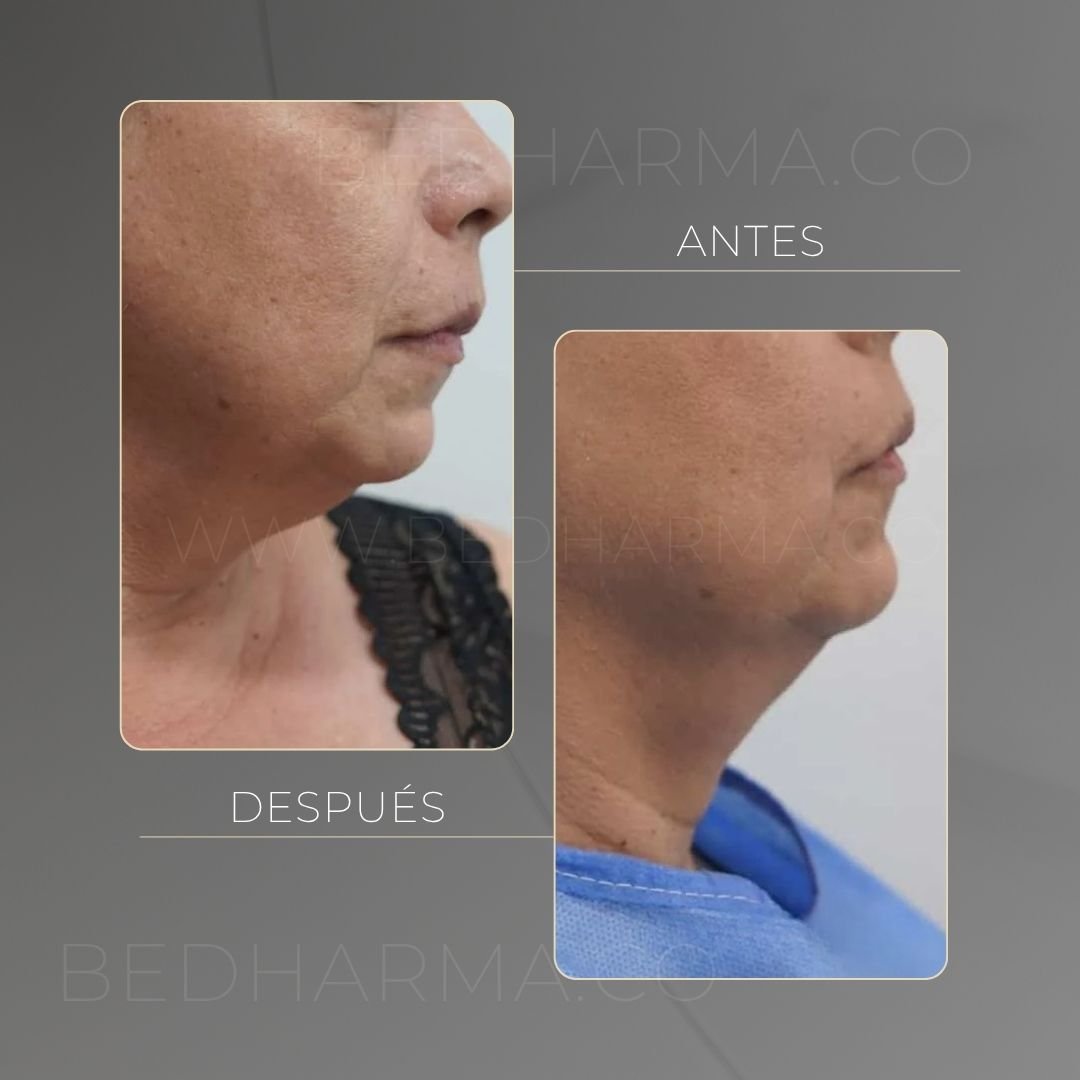 Antes y después de Cooltech para el rejuvenecimiento de la piel en Medellín - Centro Estético Be Dharma