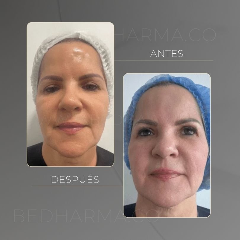 Antes y después de HarmonyCa Medellín - Centro Estético Be Dharma