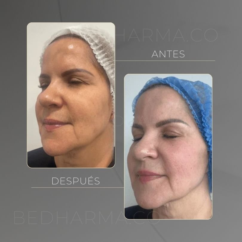 Antes y después de HarmonyCa Medellín - Centro Estético Be Dharma