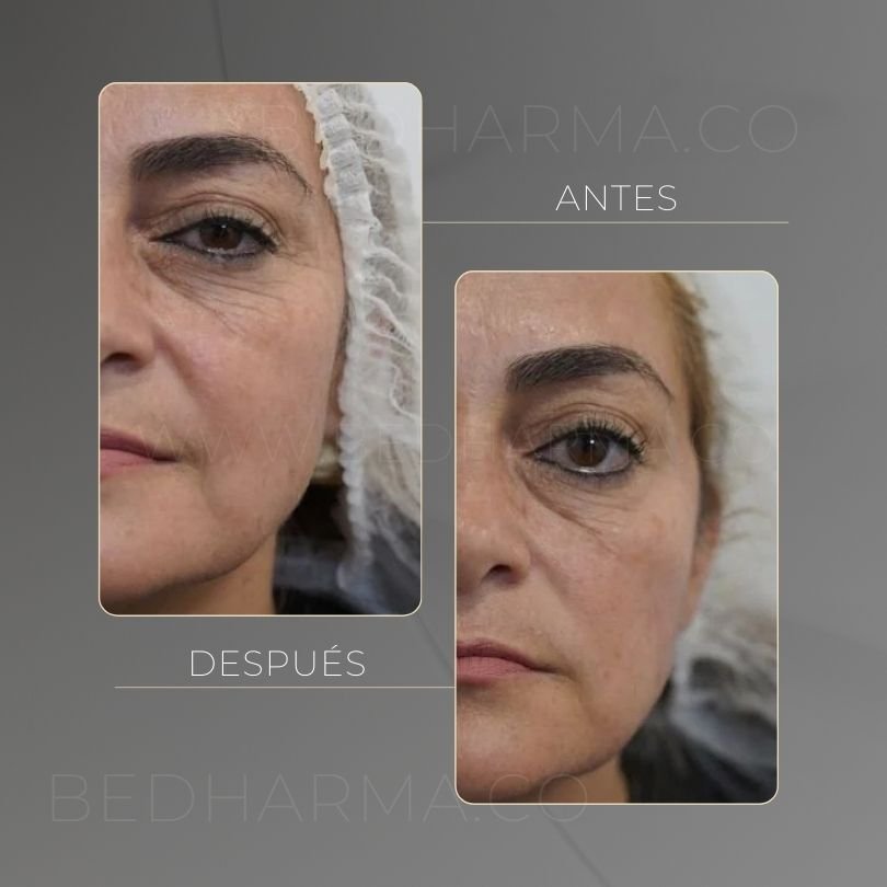 Antes y después de HarmonyCa Medellín - Centro Estético Be Dharma