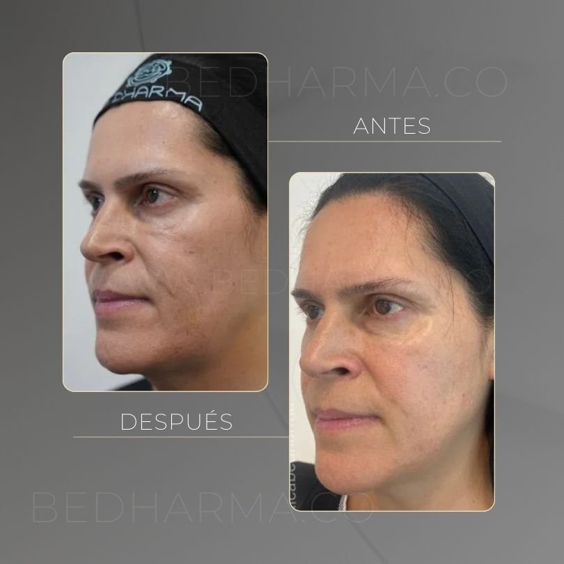 Antes y después de HarmonyCa Medellín - Centro Estético Be Dharma