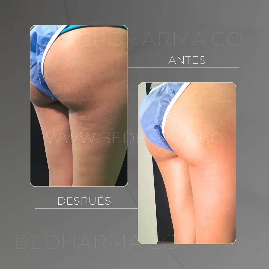Antes y después de tensamax para el rejuvenecimiento de la piel en Medellín - Centro Estético Be Dharma