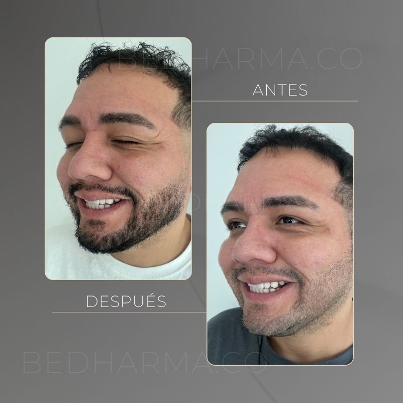 Antes y después de toxina botulinica para el rejuvenecimiento de la piel en Medellín - Centro Estético Be Dharma