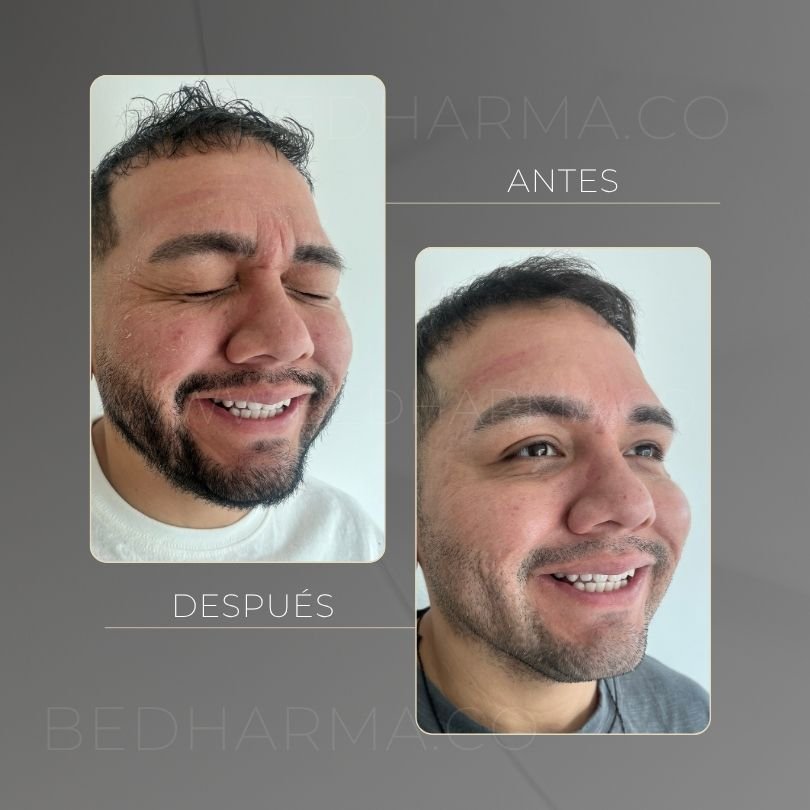 Antes y después de toxina botulinica para el rejuvenecimiento de la piel en Medellín - Centro Estético Be Dharma