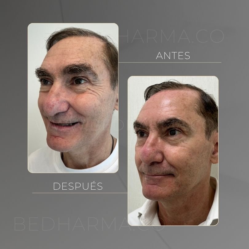 Antes y después de toxina botulinica para el rejuvenecimiento de la piel en Medellín - Centro Estético Be Dharma