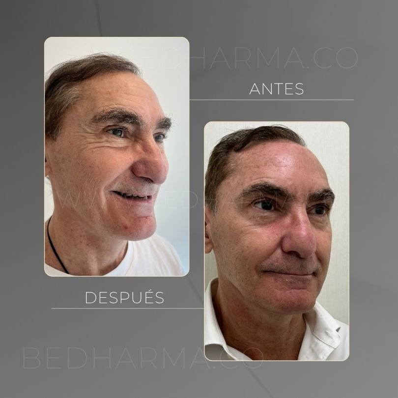 Antes y después de toxina botulinica para el rejuvenecimiento de la piel en Medellín - Centro Estético Be Dharma