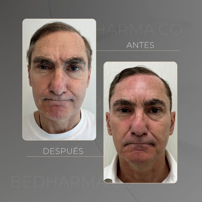 Antes y después de toxina botulinica para el rejuvenecimiento de la piel en Medellín - Centro Estético Be Dharma