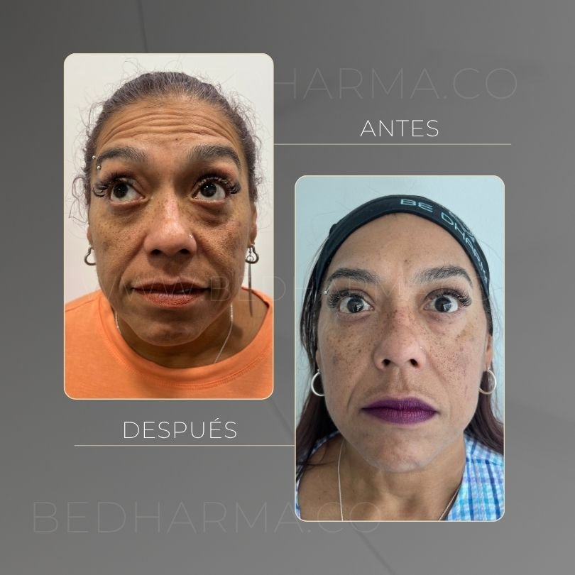 Antes y después de toxina botulinica para el rejuvenecimiento de la piel en Medellín - Centro Estético Be Dharma