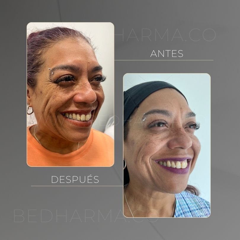 Antes y después de toxina botulinica para el rejuvenecimiento de la piel en Medellín - Centro Estético Be Dharma