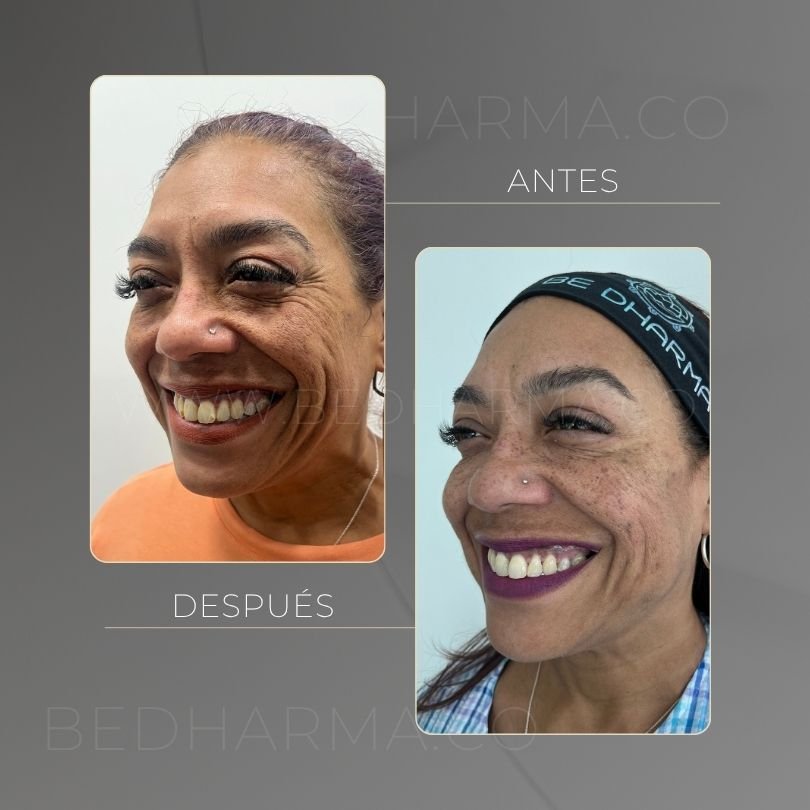 Antes y después de toxina botulinica para el rejuvenecimiento de la piel en Medellín - Centro Estético Be Dharma