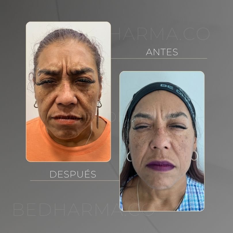 Antes y después de toxina botulinica para el rejuvenecimiento de la piel en Medellín - Centro Estético Be Dharma