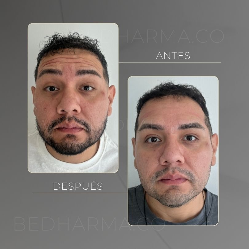 Antes y después de toxina botulinica para el rejuvenecimiento de la piel en Medellín - Centro Estético Be Dharma