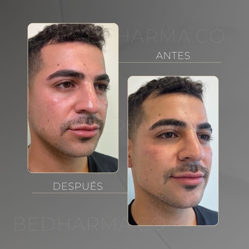 Antes y después del ácido hialurónico para el rejuvenecimiento de la piel en Medellín - Centro Estético Be Dharma