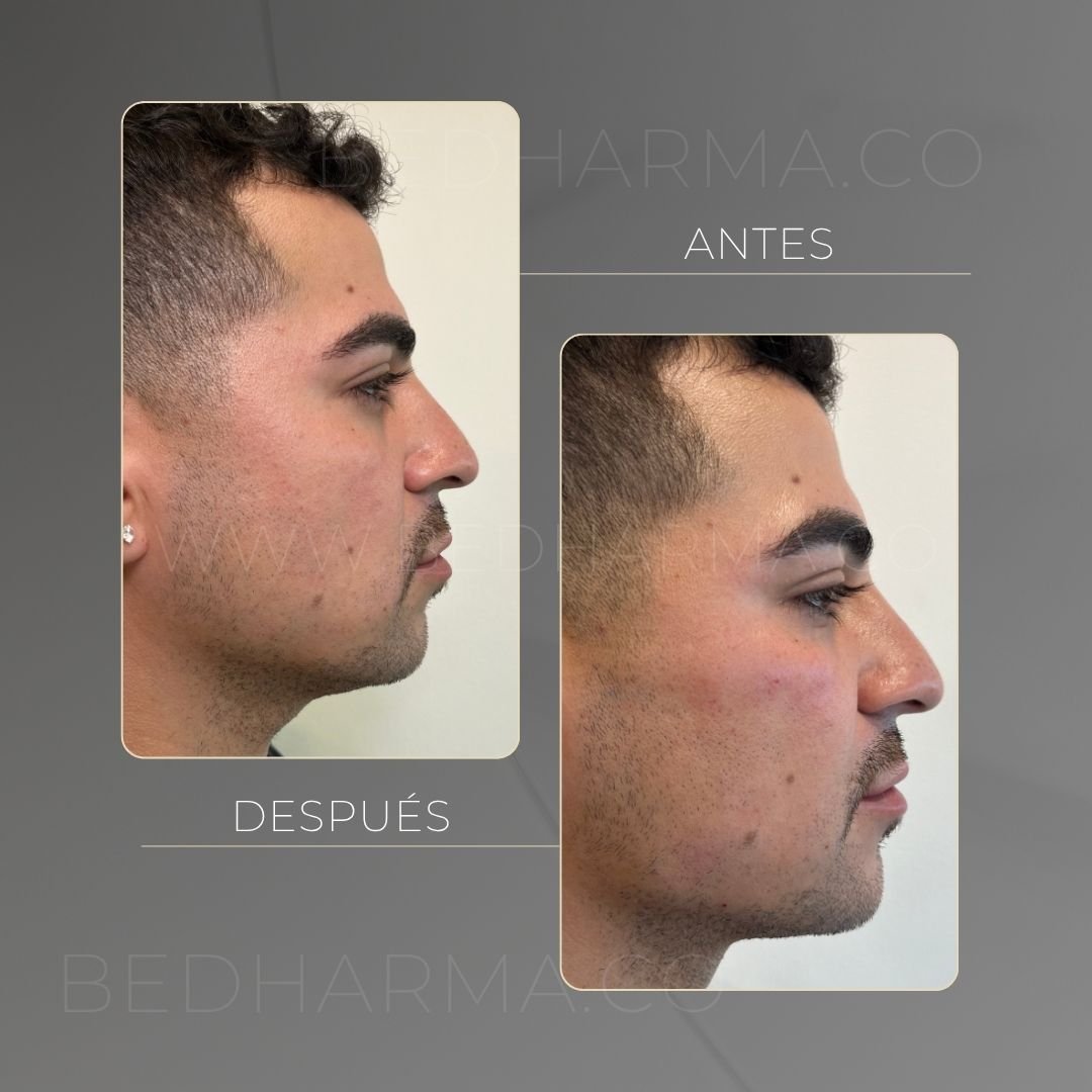 Antes y después del ácido hialurónico para el rejuvenecimiento de la piel en Medellín - Centro Estético Be Dharma