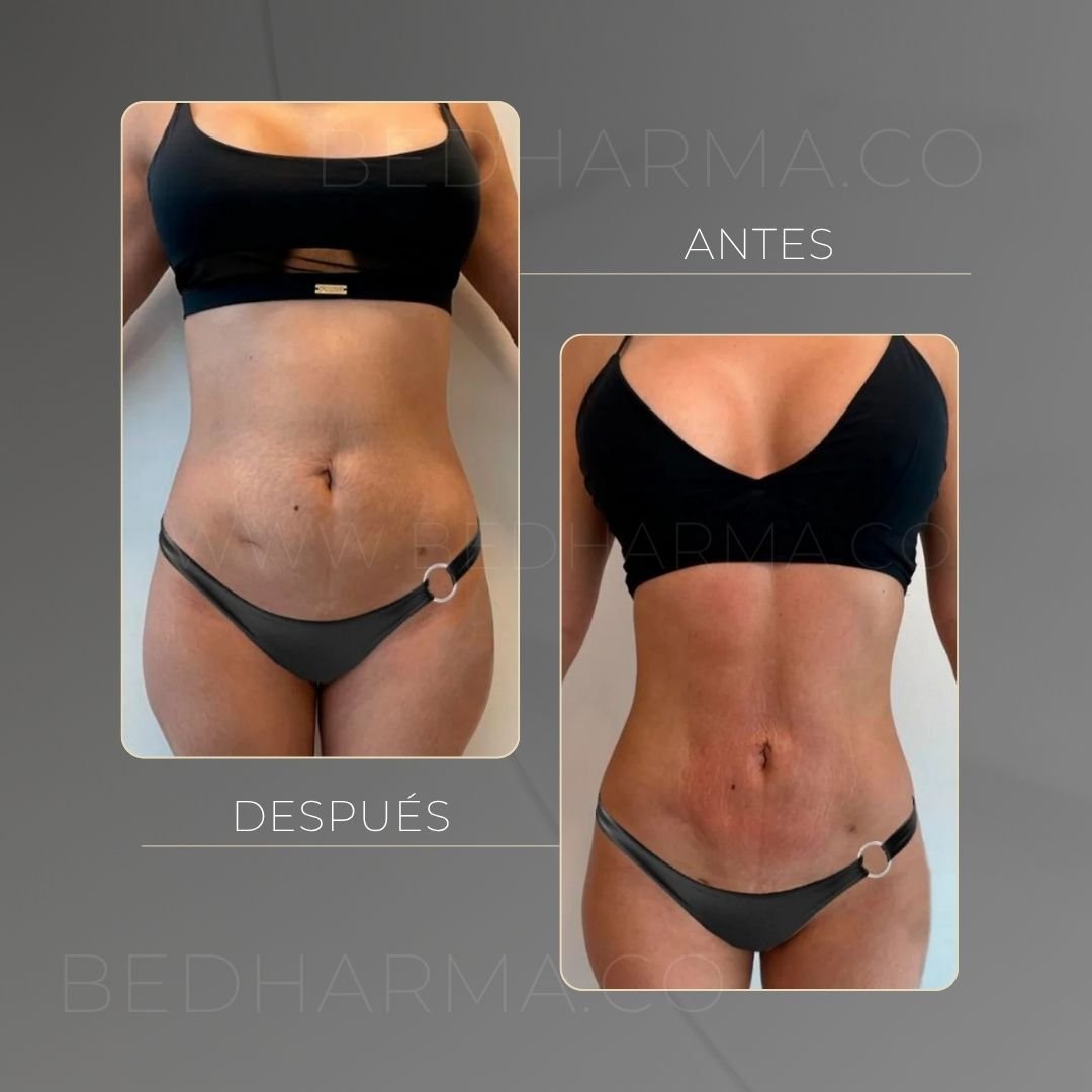 BodyTite before and after at Be Dharma in Medellín — case 1
