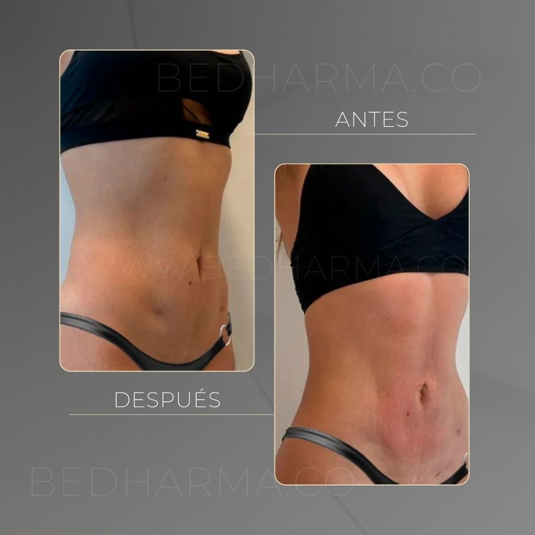 BodyTite before and after at Be Dharma in Medellín — case 2