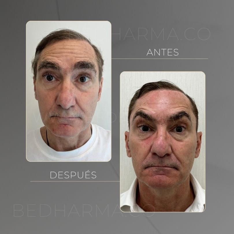 Botulinum toxin before and after at Be Dharma in Medellín — case 11