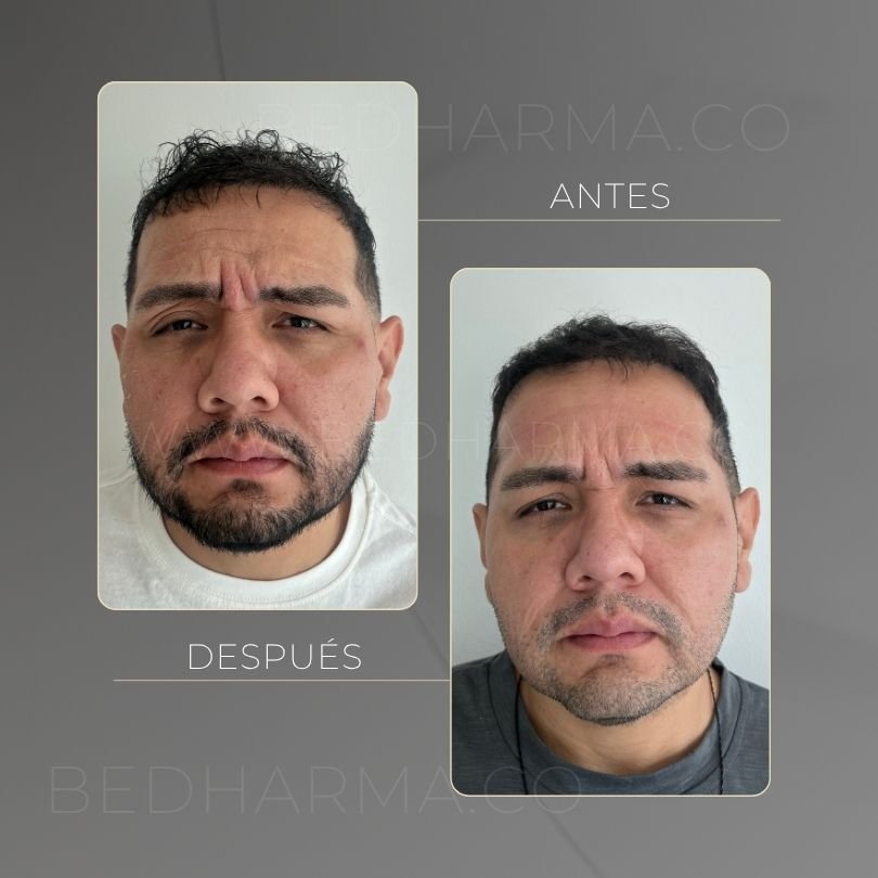Botulinum toxin before and after at Be Dharma in Medellín — case 12