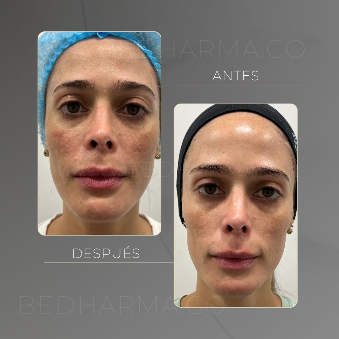 ColorMAX laser before and after in Medellín at Clínica Be Dharma — case 10