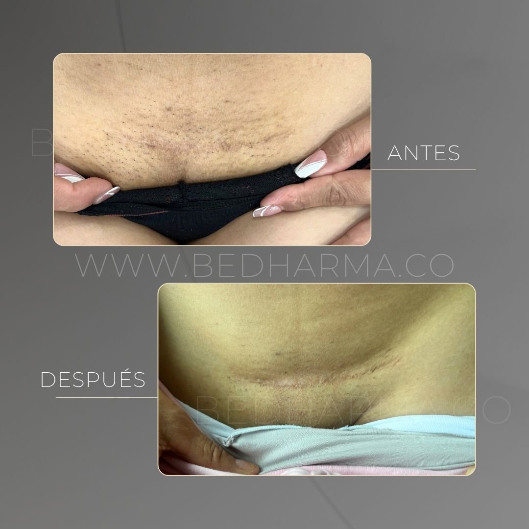 ColorMAX laser before and after in Medellín at Clínica Be Dharma — case 11