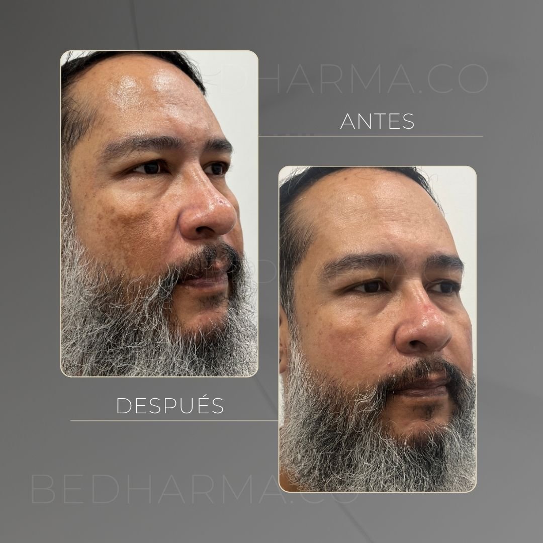 ColorMAX laser before and after in Medellín at Clínica Be Dharma — case 12