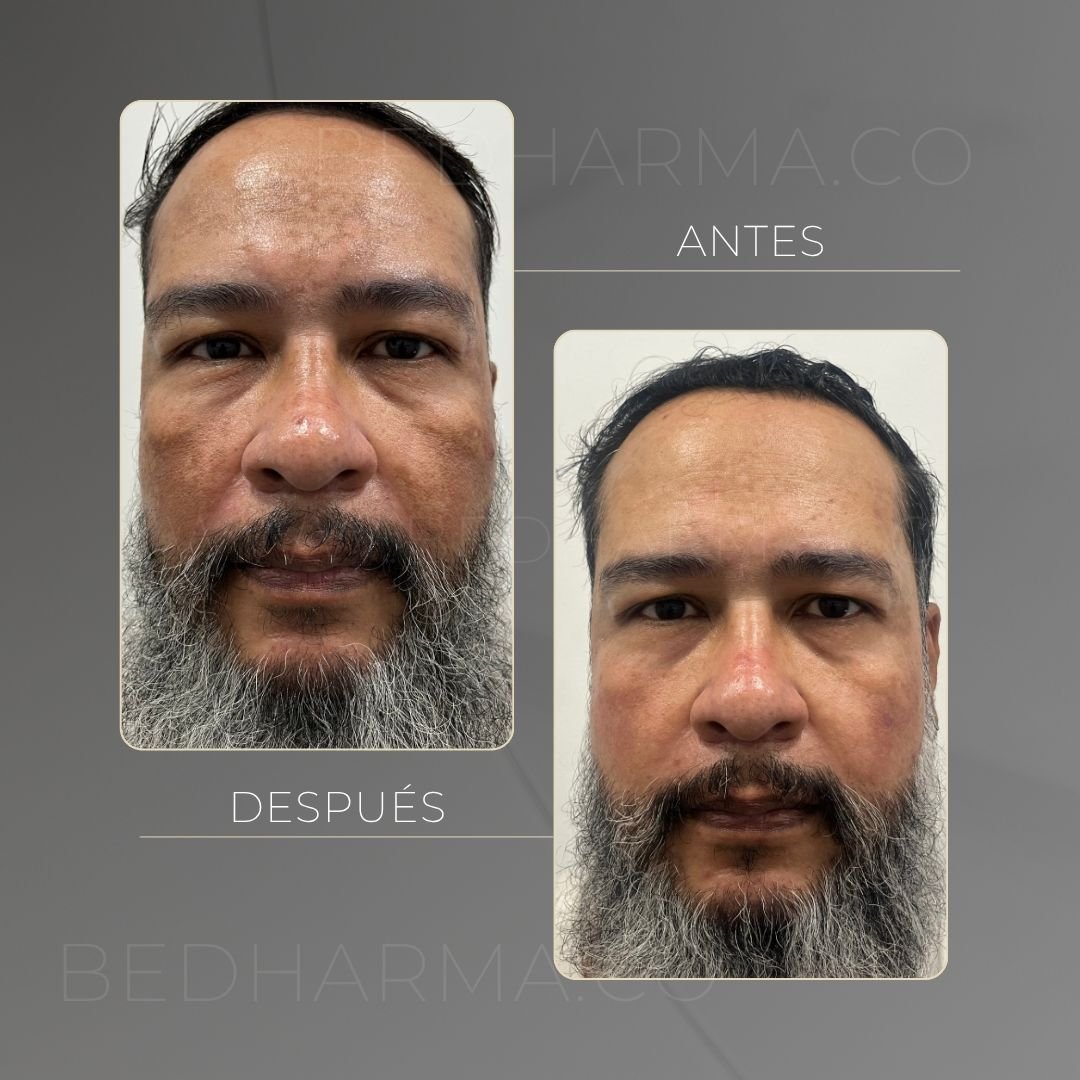 ColorMAX laser before and after in Medellín at Clínica Be Dharma — case 14