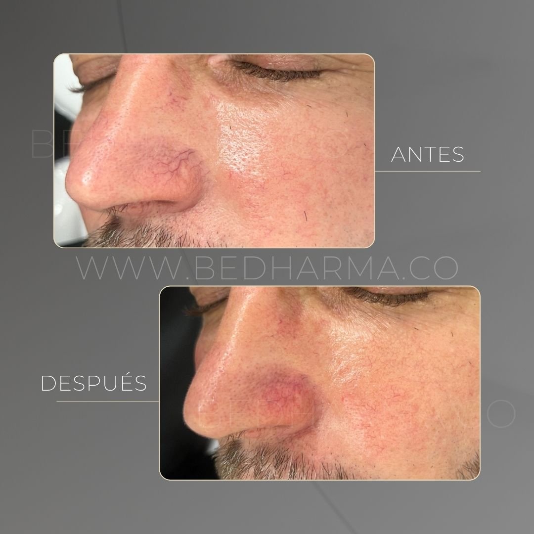 ColorMAX laser before and after in Medellín at Clínica Be Dharma — case 15