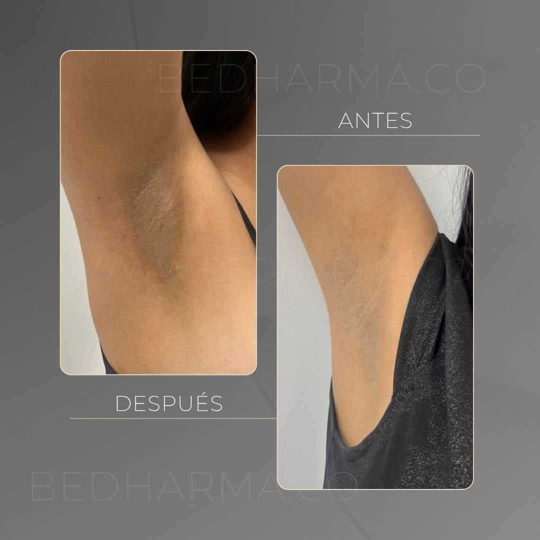 ColorMAX laser before and after in Medellín at Clínica Be Dharma — case 16