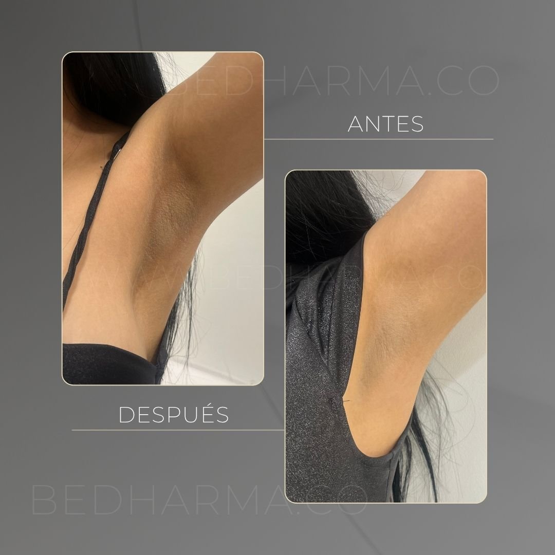 ColorMAX laser before and after in Medellín at Clínica Be Dharma — case 17