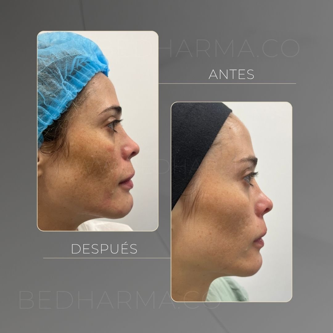 ColorMAX laser before and after in Medellín at Clínica Be Dharma — case 8
