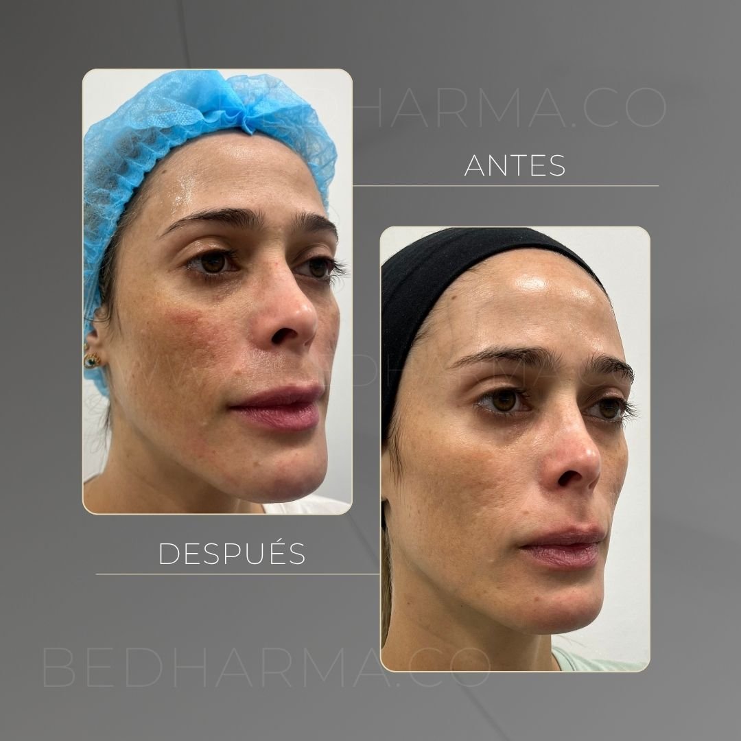 ColorMAX laser before and after in Medellín at Clínica Be Dharma — case 9