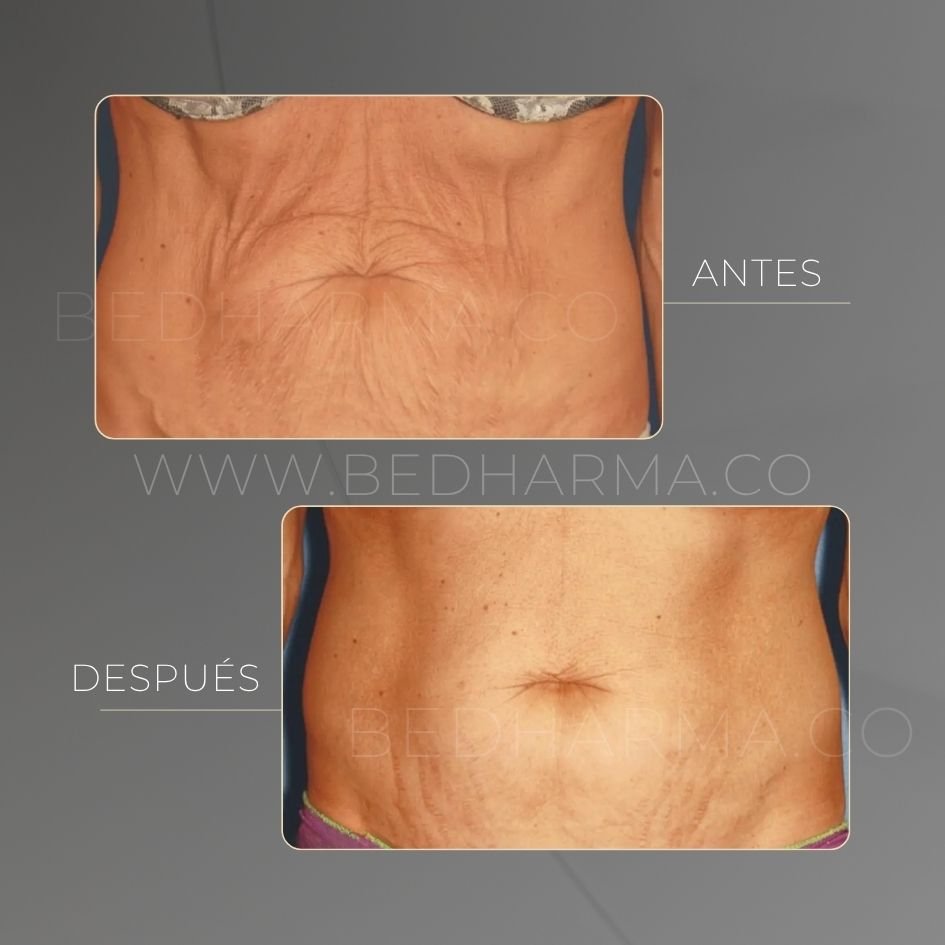 Forma Plus before and after for skin tightening in Medellín