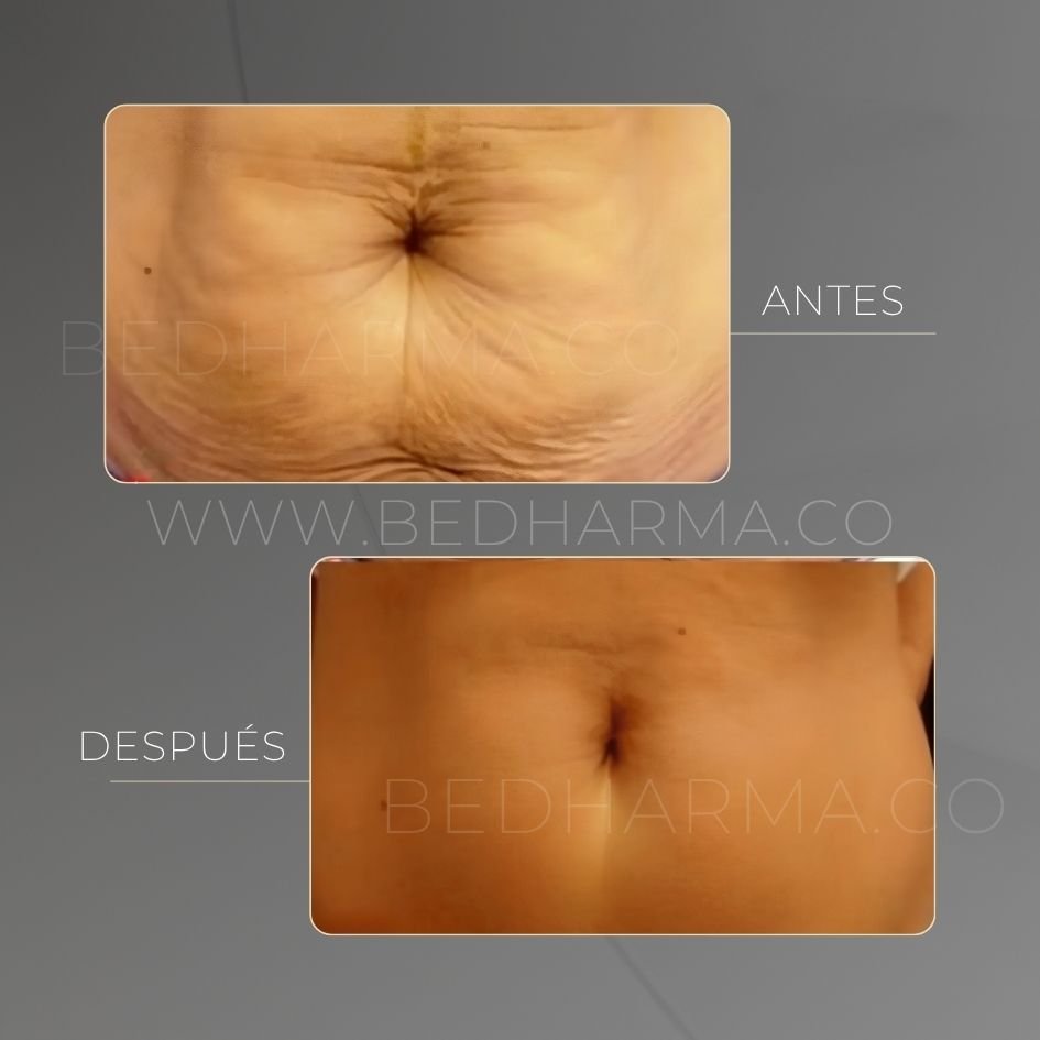 Forma Plus before and after results at Be Dharma Medellín