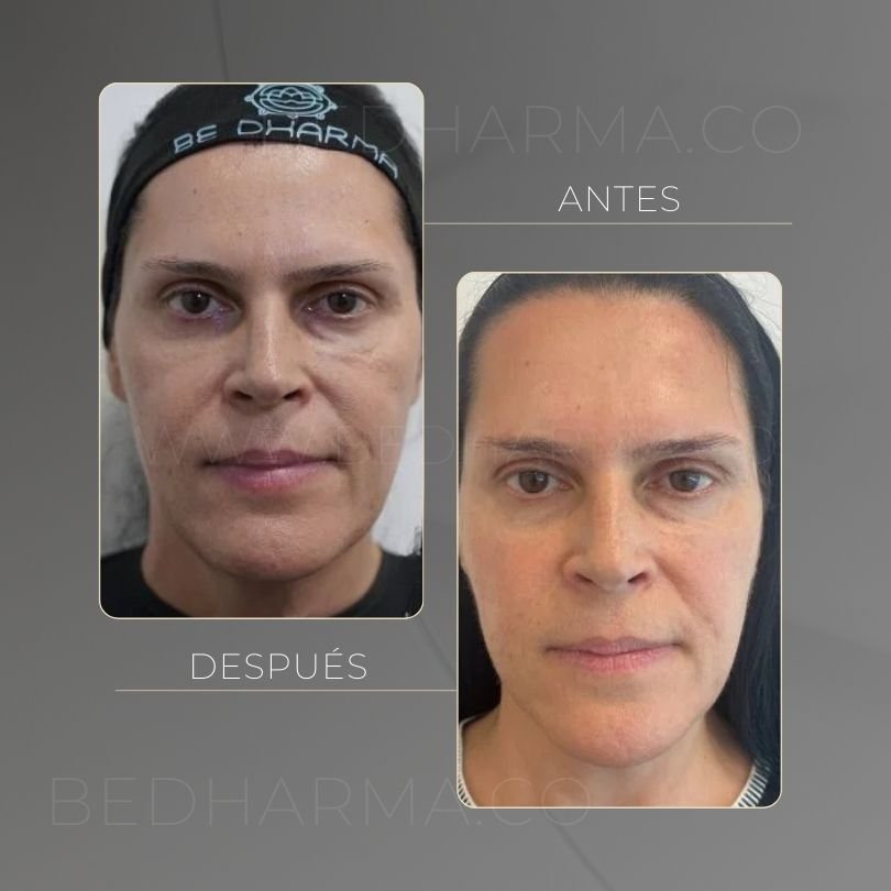HarmonyCa jawline before and after at Be Dharma Medellín