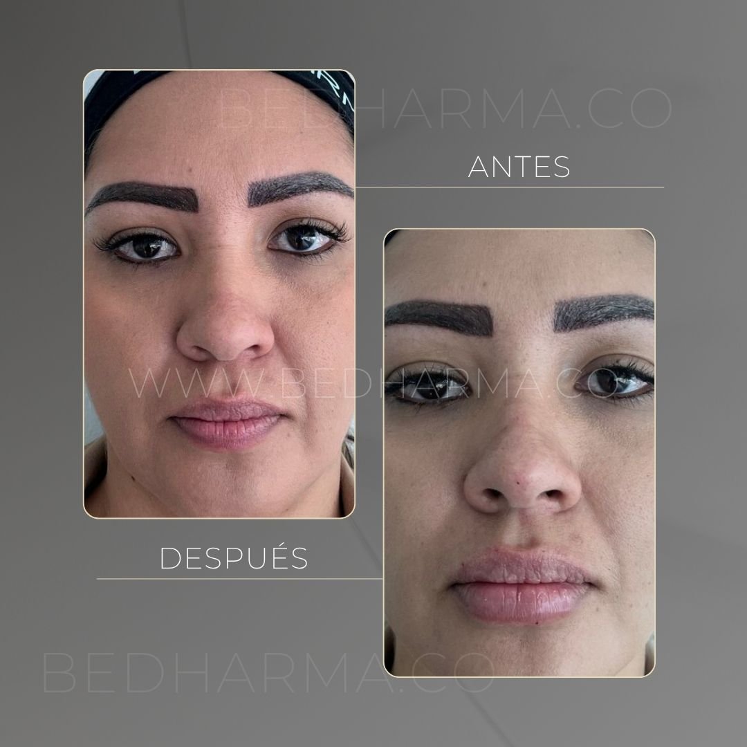 Hyaluronic acid facial rejuvenation before and after in Medellín at Be Dharma — case 1