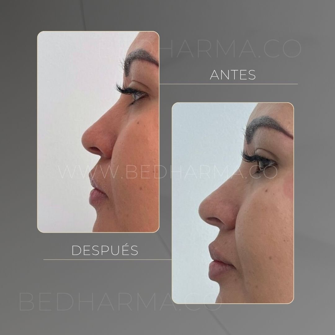Hyaluronic acid facial rejuvenation before and after in Medellín at Be Dharma — case 2
