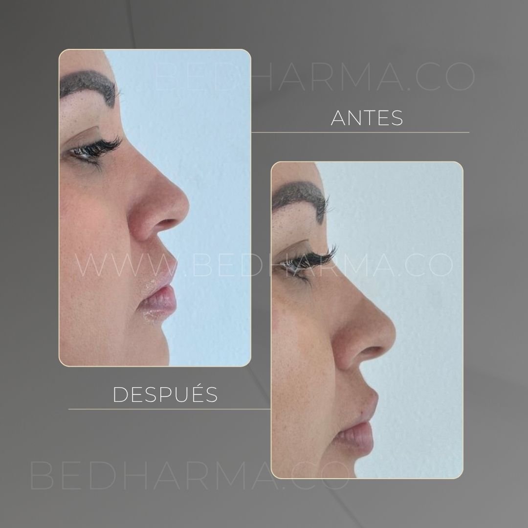 Hyaluronic acid facial rejuvenation before and after in Medellín at Be Dharma — case 3