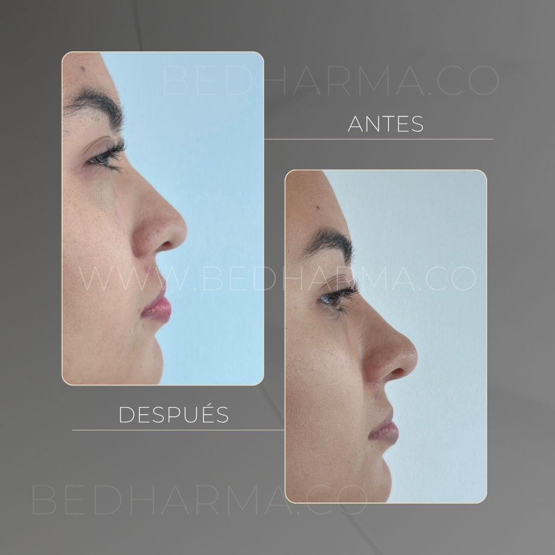 Hyaluronic acid facial rejuvenation before and after in Medellín at Be Dharma — case 4