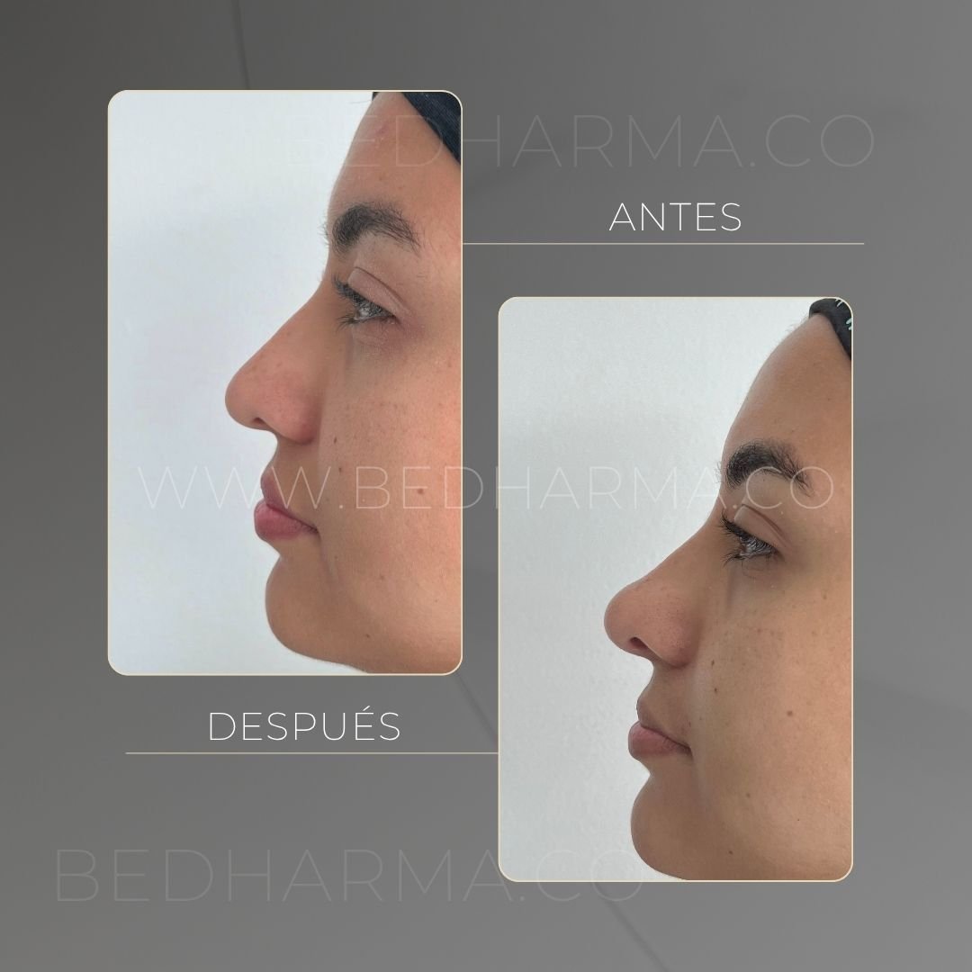 Hyaluronic acid facial rejuvenation before and after in Medellín at Be Dharma — case 5