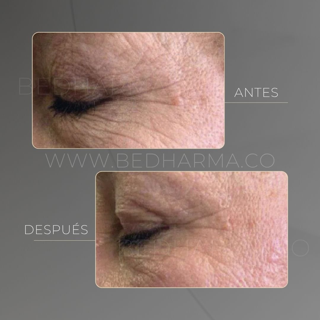 Indiba before and after at Be Dharma in Medellín — case 1