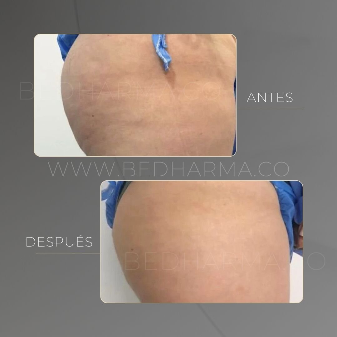 Indiba before and after at Be Dharma in Medellín — case 2
